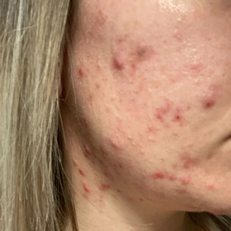 Renewed problem skin