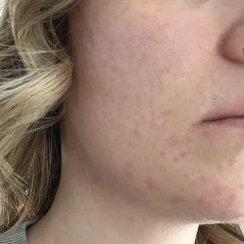 Renewed problem skin