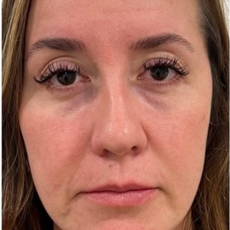 Lifted & sculpted face