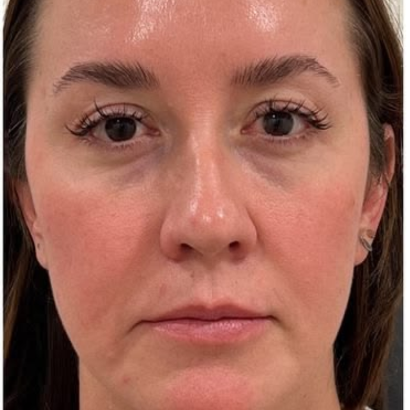 Lifted & sculpted face
