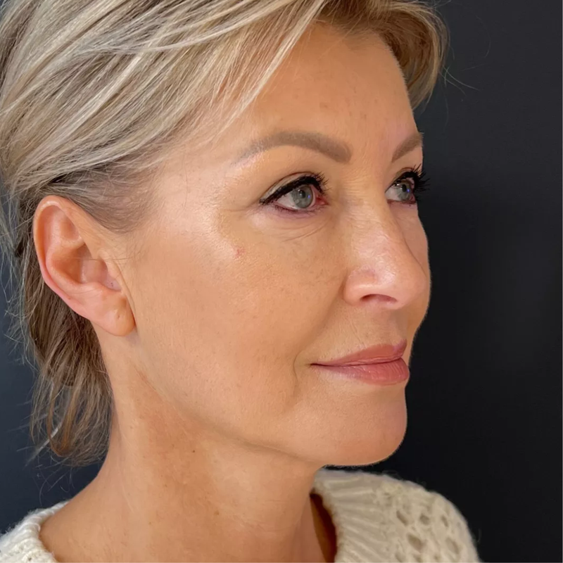 Younger neck and jawline